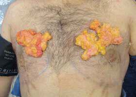 Gynecomastia Surgery Before & After Image