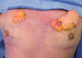 Gynecomastia Surgery Before & After Image