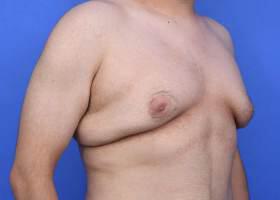 Gynecomastia Surgery Before & After Image
