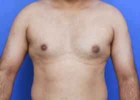 Gynecomastia Surgery Before & After Image