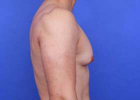 Gynecomastia Surgery Before & After Image