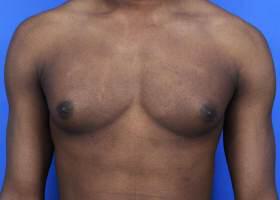 Gynecomastia Surgery Before & After Image