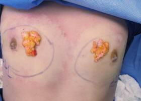 Gynecomastia Surgery Before & After Image