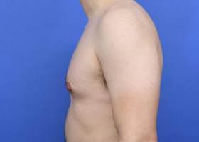 Gynecomastia Surgery Before & After Image