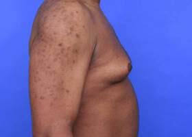 Gynecomastia Surgery Before & After Image