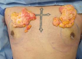 Gynecomastia Surgery Before & After Image