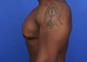 Gynecomastia Surgery Before & After Image