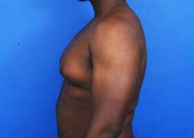 Gynecomastia Surgery Before & After Image