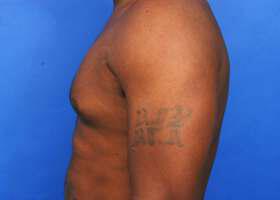 Gynecomastia Surgery Before & After Image