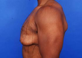 Gynecomastia Surgery Before & After Image