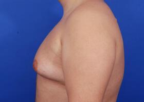 Gynecomastia Surgery Before & After Image