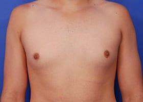 Gynecomastia Surgery Before & After Image