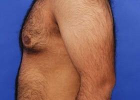 Gynecomastia Surgery Before & After Image