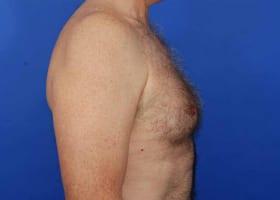 Gynecomastia Surgery Before & After Image