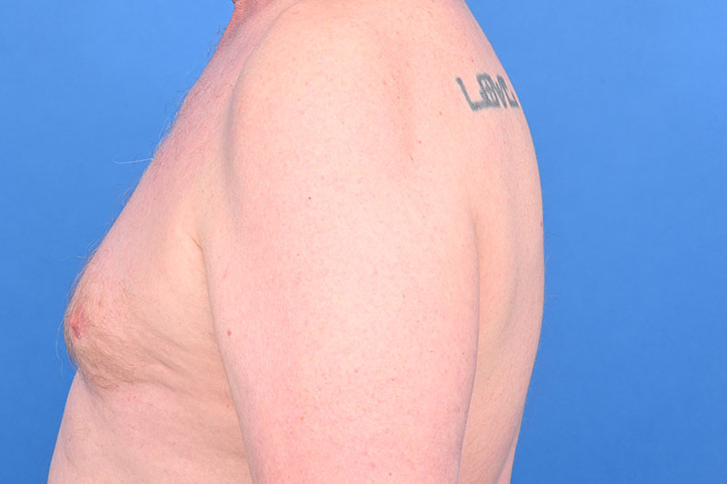 Gynecomastia Surgery Before & After Image