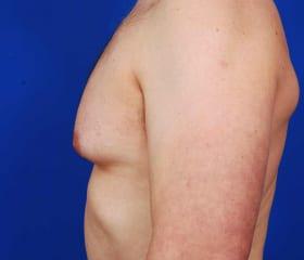Gynecomastia Surgery Before & After Image