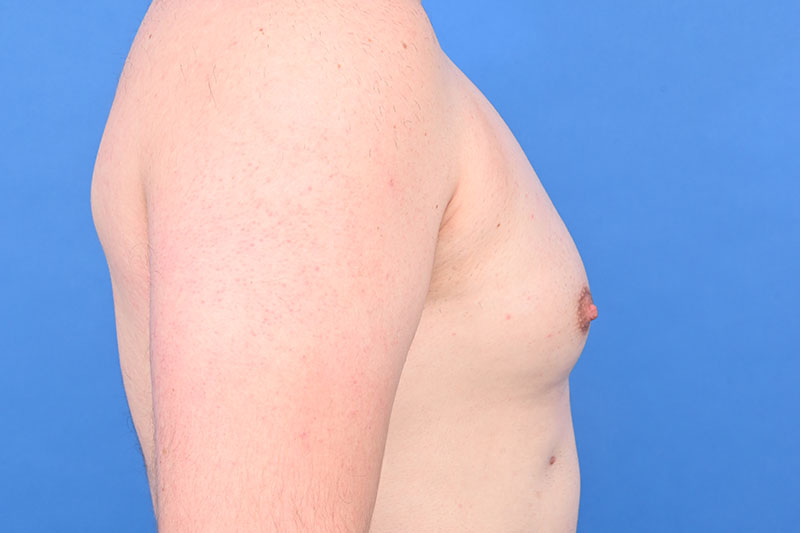 Gynecomastia Surgery Before & After Image