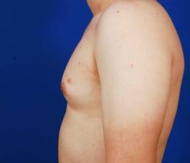 Gynecomastia Surgery Before & After Image