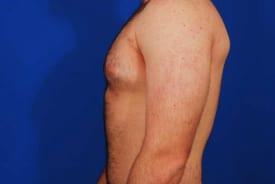 Gynecomastia Surgery Before & After Image