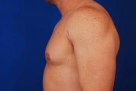 Gynecomastia Surgery Before & After Image