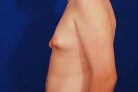 Gynecomastia Surgery Before & After Image