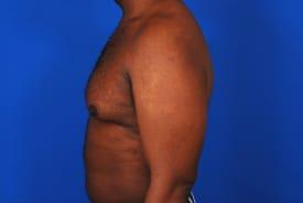 Gynecomastia Surgery Before & After Image