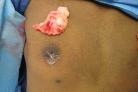 Gynecomastia Surgery Before & After Image