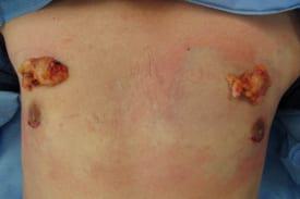 Gynecomastia Surgery Before & After Image