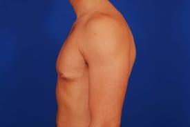 Gynecomastia Surgery Before & After Image
