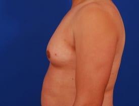 Gynecomastia Surgery Before & After Image