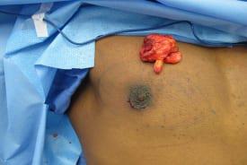 Gynecomastia Surgery Before & After Image