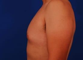 Gynecomastia Surgery Before & After Image