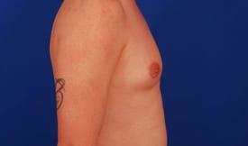 Gynecomastia Surgery Before & After Image