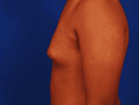 Gynecomastia Surgery Before & After Image