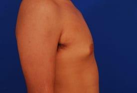 Gynecomastia Surgery Before & After Image