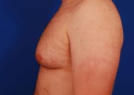 Gynecomastia Surgery Before & After Image