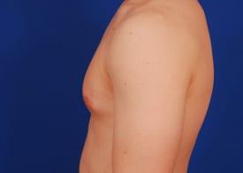 Gynecomastia Surgery Before & After Image