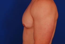Gynecomastia Surgery Before & After Image