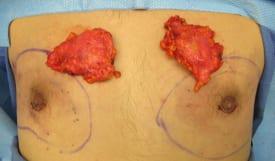 Gynecomastia Surgery Before & After Image