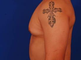 Gynecomastia Surgery Before & After Image