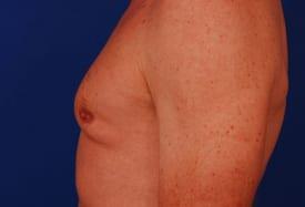 Gynecomastia Surgery Before & After Image