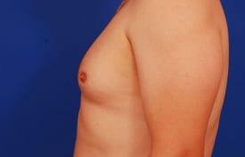 Gynecomastia Surgery Before & After Image