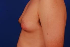 Gynecomastia Surgery Before & After Image