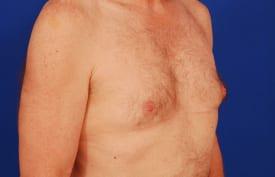 Gynecomastia Surgery Before & After Image