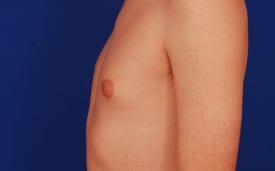 Gynecomastia Surgery Before & After Image