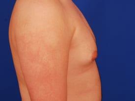 Gynecomastia Surgery Before & After Image