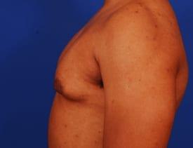 Gynecomastia Surgery Before & After Image