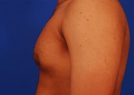 Gynecomastia Surgery Before & After Image