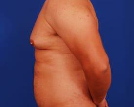 Gynecomastia Surgery Before & After Image