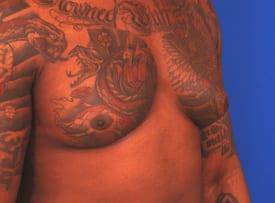 Gynecomastia Surgery Before & After Image